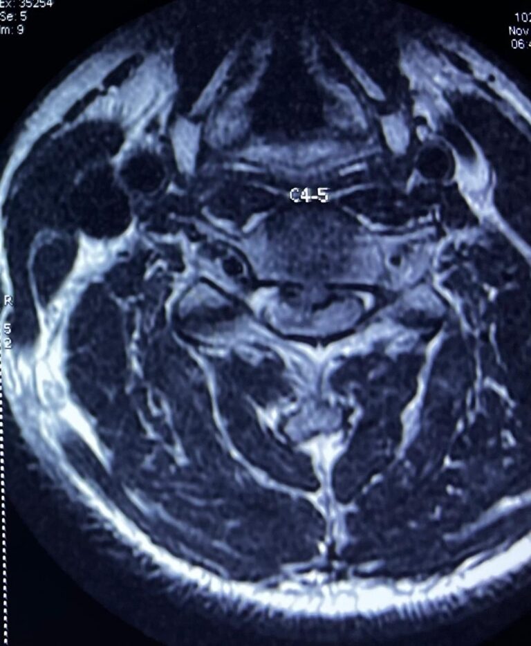 Cervical Melopathy Surgeon Vizag