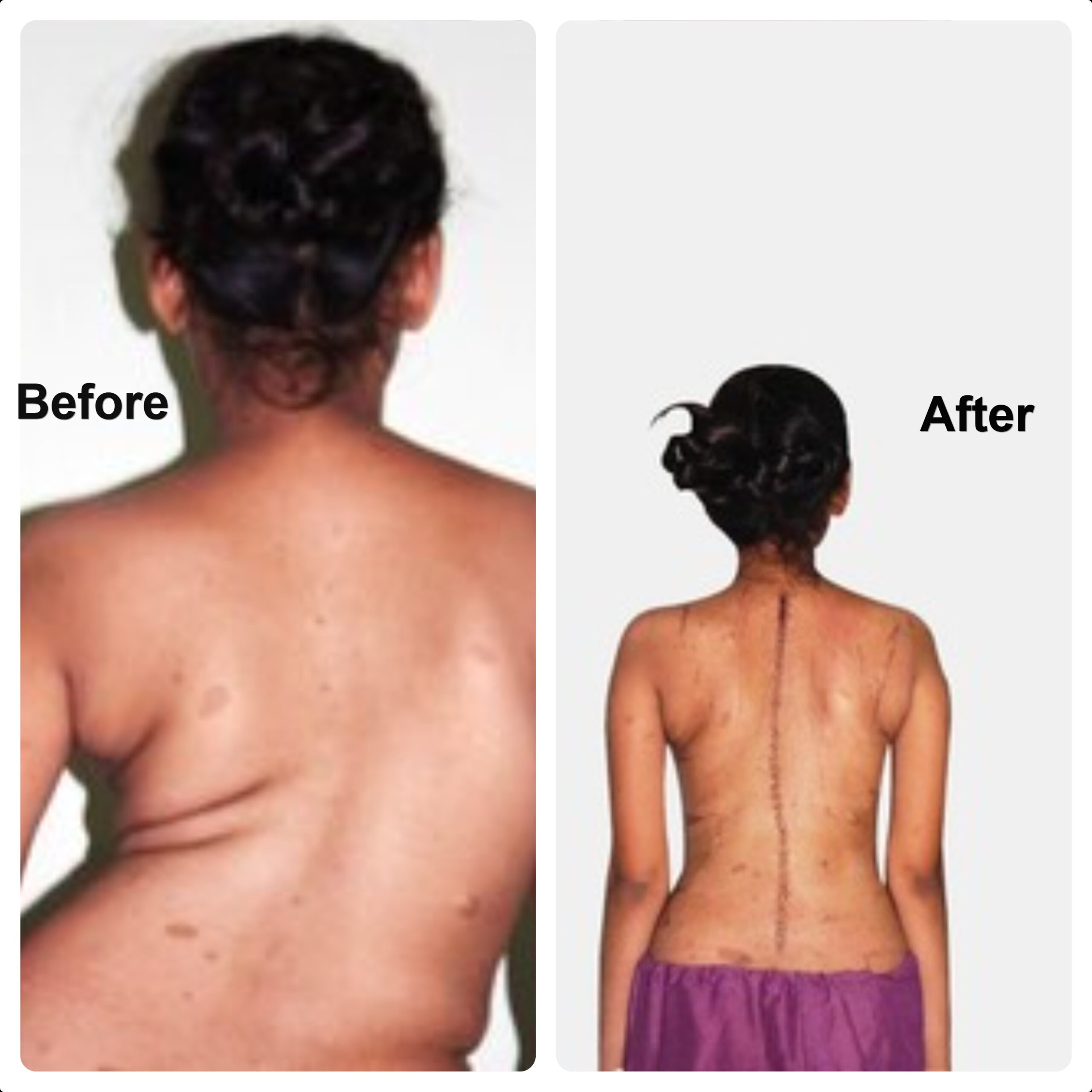 Scoliosis Treatment in Vizag: Consult the Best Spine Surgeon in Vizag for Lasting Relief