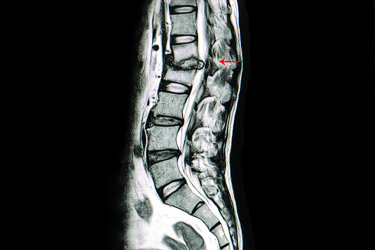 TB Spine Treatment