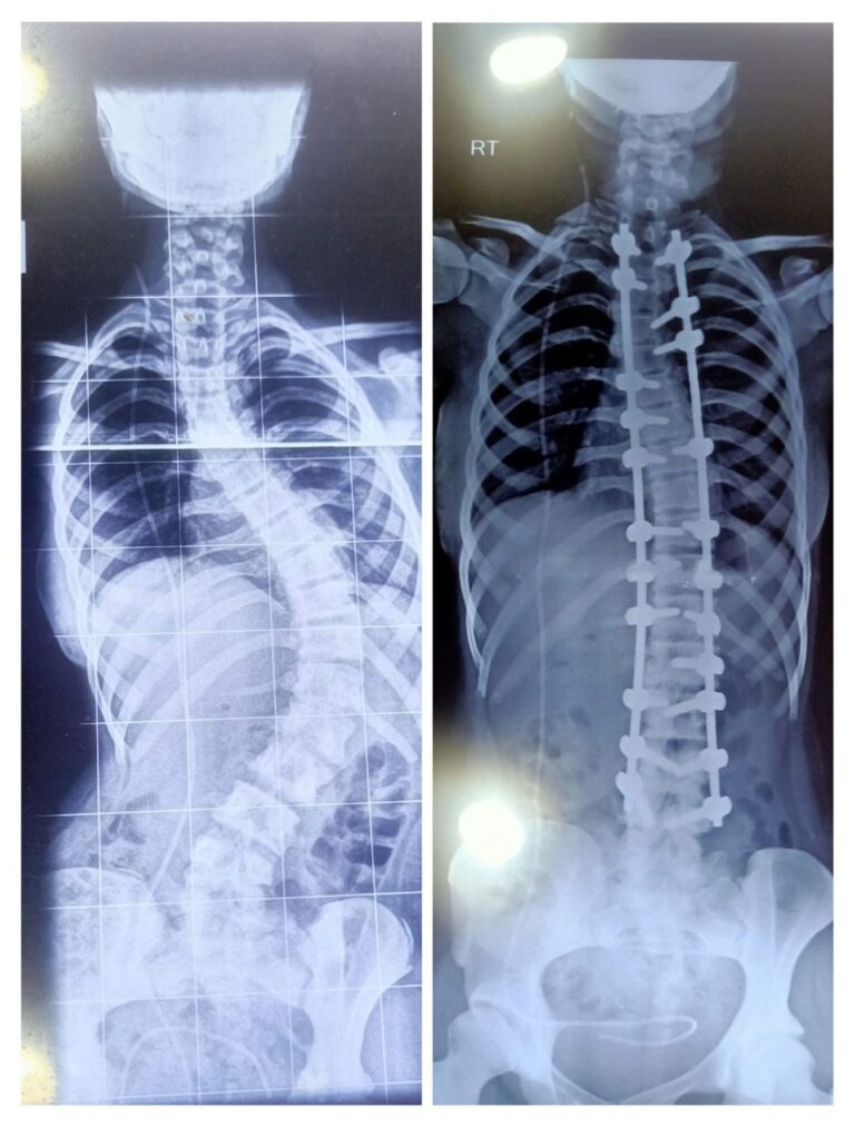 Scoliosis Treatment in Vizag