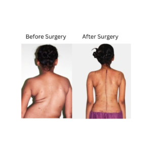 Scoliosis Treatment