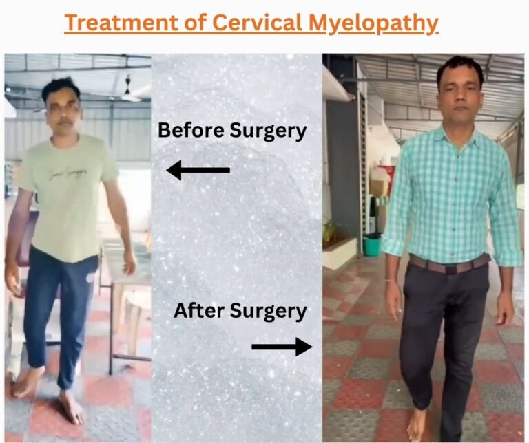 Cervical Myelopathy Surgery Vizag